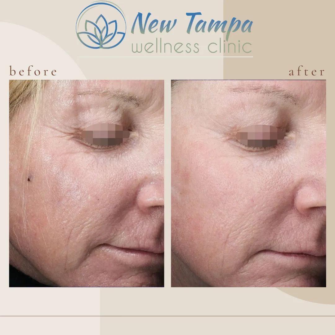 Side-by-side before and after photos of a woman's face showing improved skin texture and reduced wrinkles after treatment at New Tampa wellness clinic.
