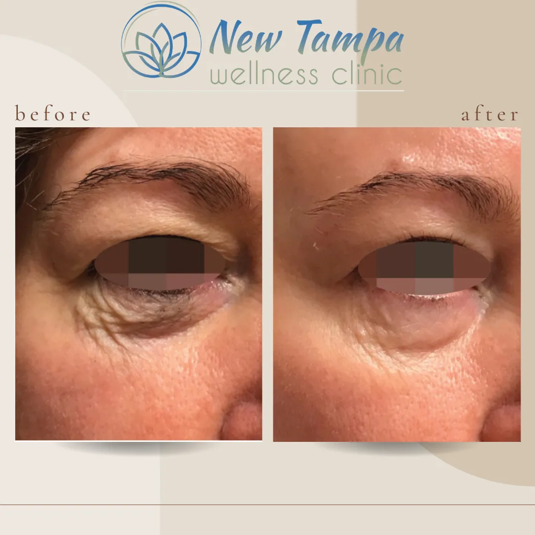 Side-by-side before and after close-up images of a person's eye area showing reduced wrinkles and smoother skin after treatment at New Tampa Wellness Clinic.