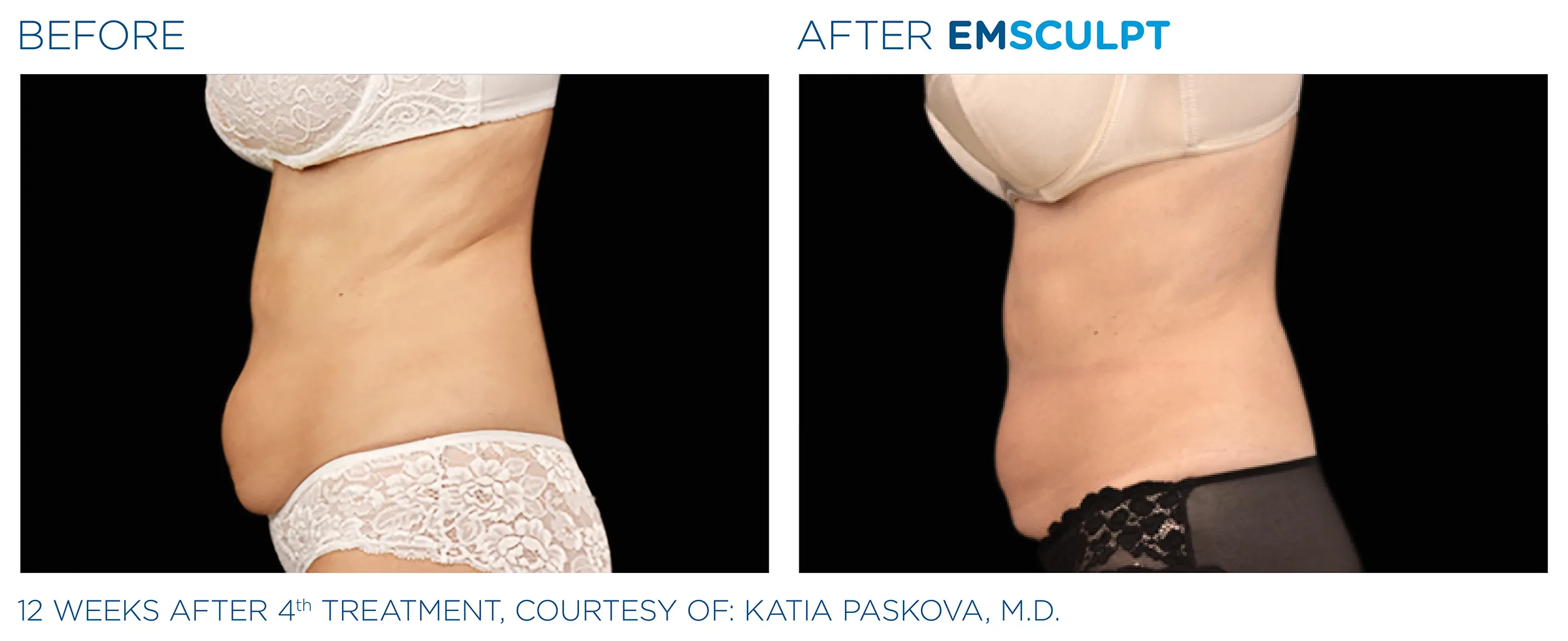 Emscuplt Neo Before and After image