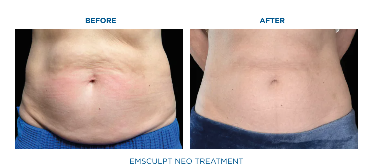 Emscuplt Neo Before and After image