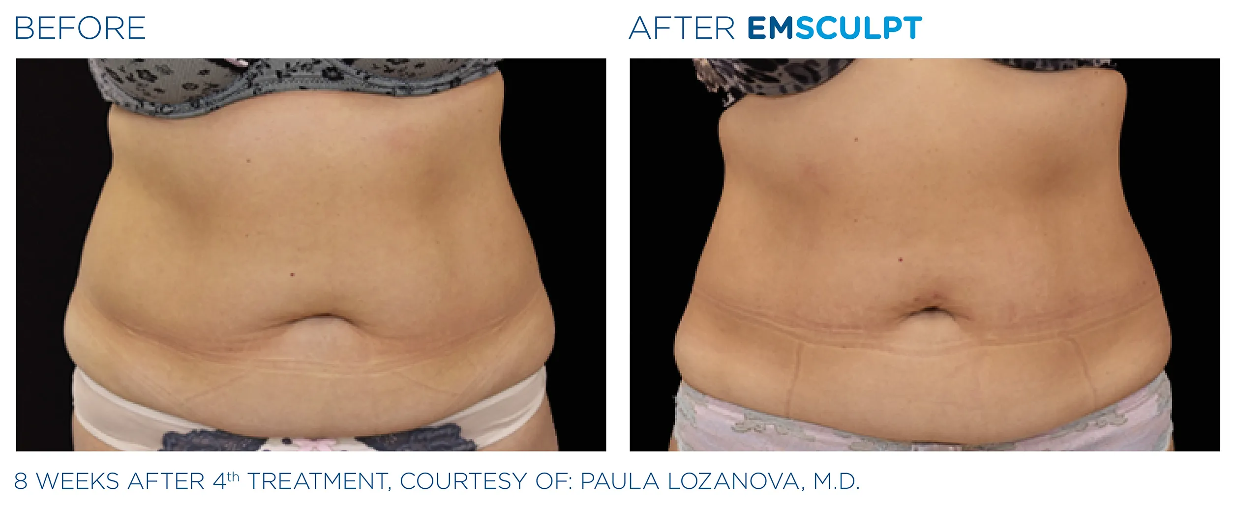 Emscuplt Neo Before and After image
