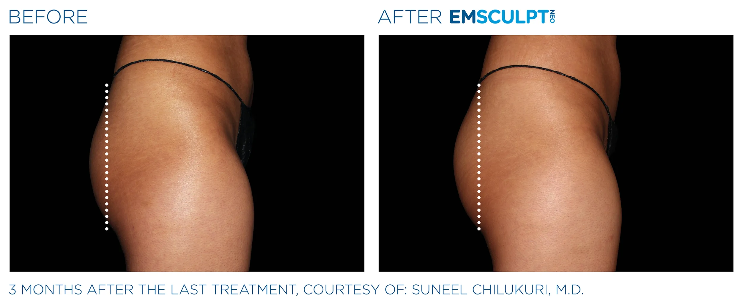 Emscuplt Neo Before and After image