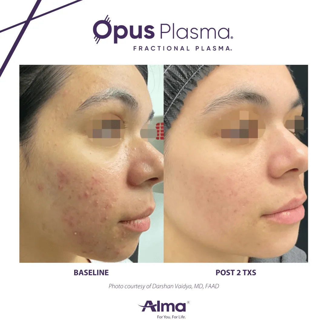 Side-by-side comparison of a woman's cheek before and after two Opus Plasma treatments, showing reduced acne and smoother skin texture.