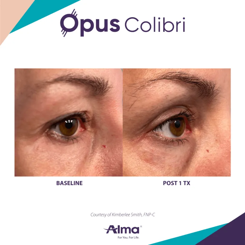 Close-up comparison of the skin around a brown eye before and after one Opus Colibri treatment, showing reduced wrinkles and smoother skin post-treatment.