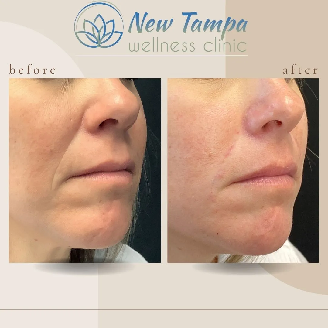 Side-by-side close-ups of a woman's lower face showing before and after skin treatment results at New Tampa Wellness Clinic.