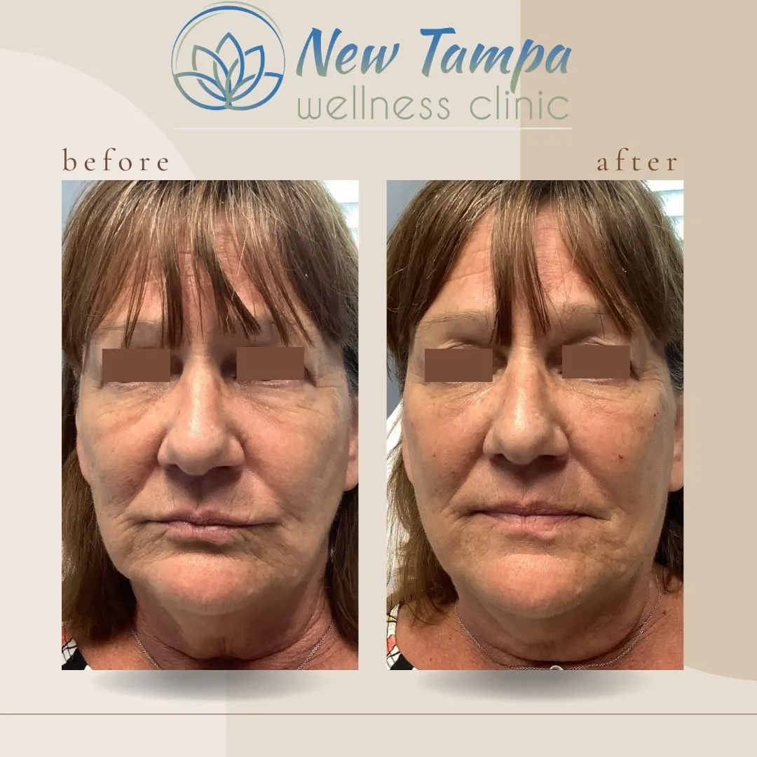 Side-by-side before and after photos of a woman's face showing subtle skin smoothing and reduced wrinkles after treatment at New Tampa wellness clinic.