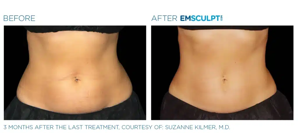 Before and after images showing a slimmer, toned female abdomen after Emsculpt treatment.