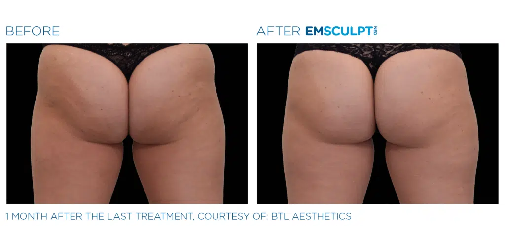 Before and after photos show firmer, lifted buttocks one month after EMSCULPT NEO treatment.