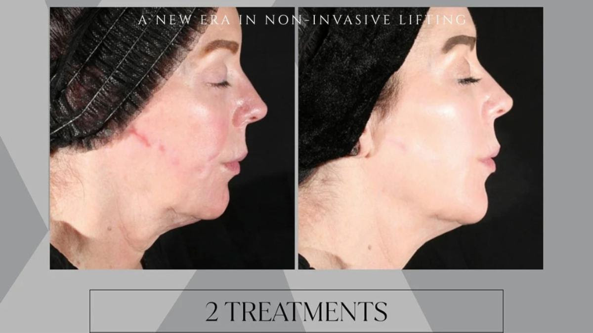 Side-by-side before and after profile photos showing facial skin improvement after two non-invasive lifting treatments.