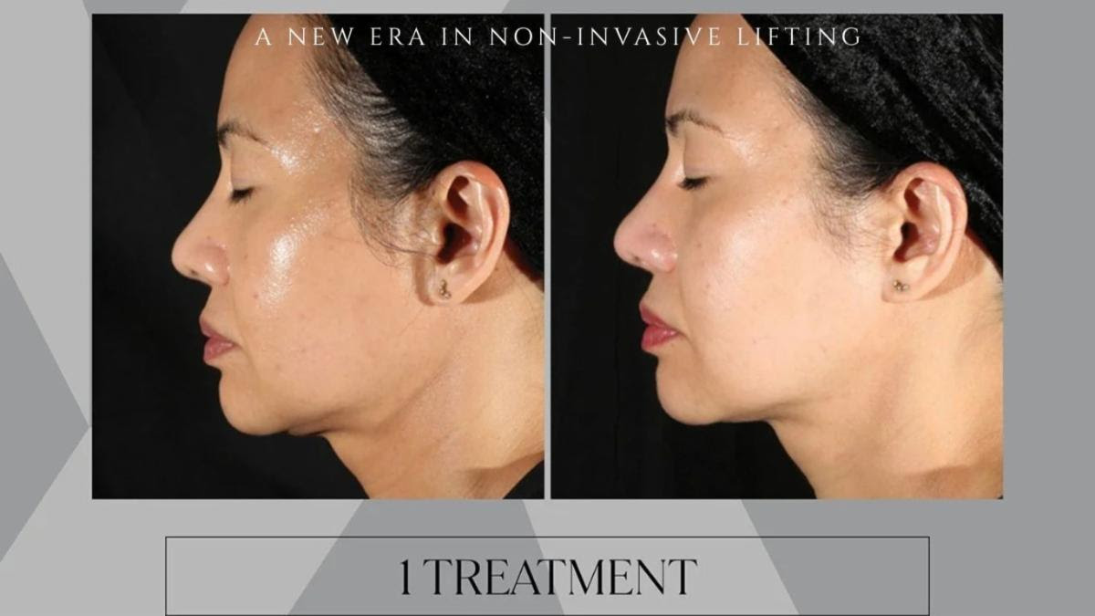 Side-by-side before and after photos of a woman showing facial lifting effects after one treatment.