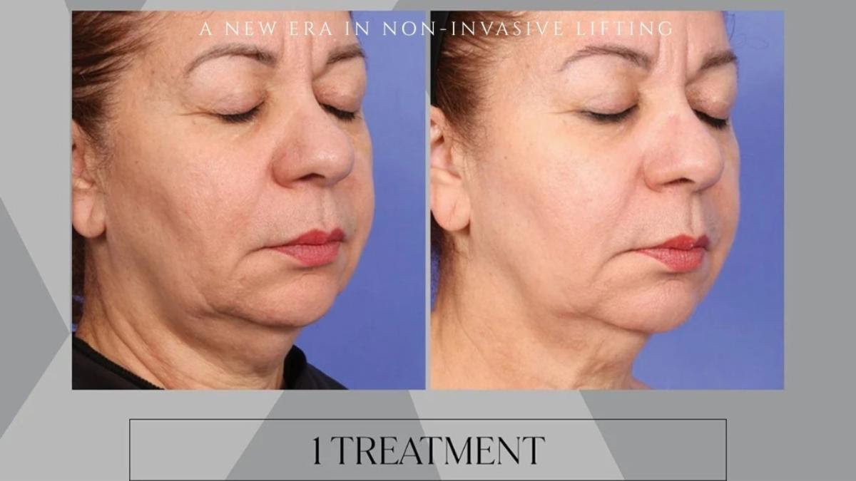 Side-by-side before and after photos showing smoother, tighter skin after one non-invasive lifting treatment.