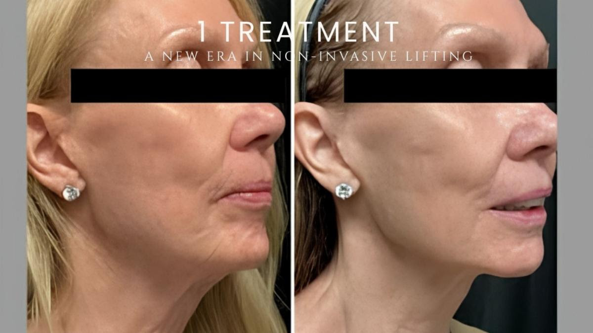 Side-by-side comparison of a woman's face before and after one non-invasive lifting treatment.