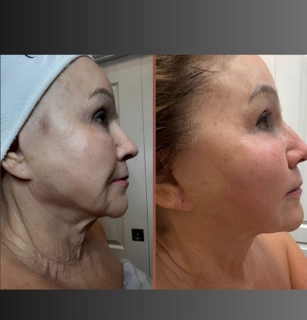 Side-by-side before and after profile photos showing facial skin improvement after two non-invasive lifting treatments.