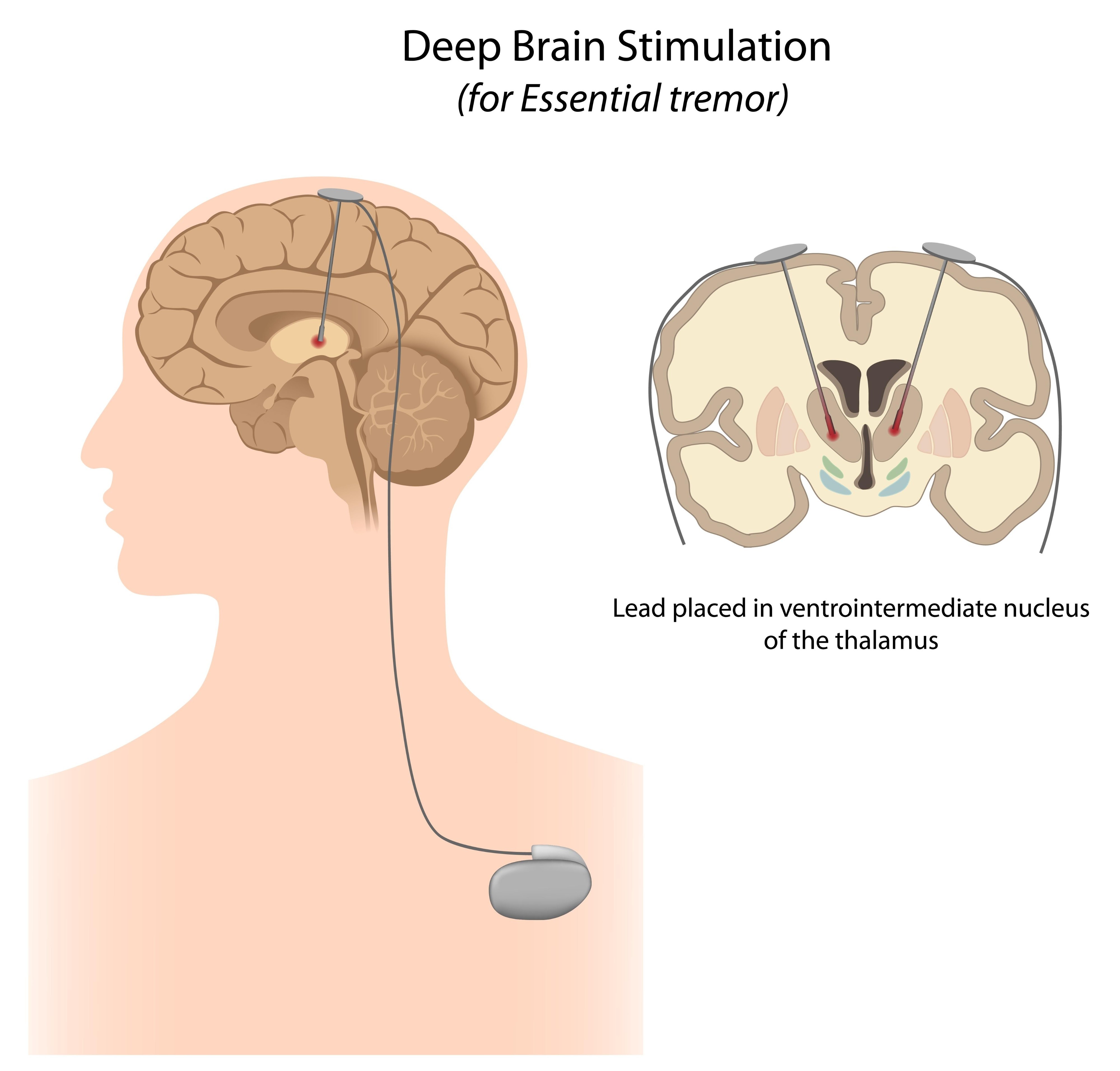 Deep Brain Stimulation electrode placement, AI generated