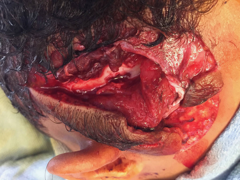 7 year-old boy mauled by Pit-Bull/Mastif. 50 cm complex lacerations with scalp avulsion and penetrating skull fracture.