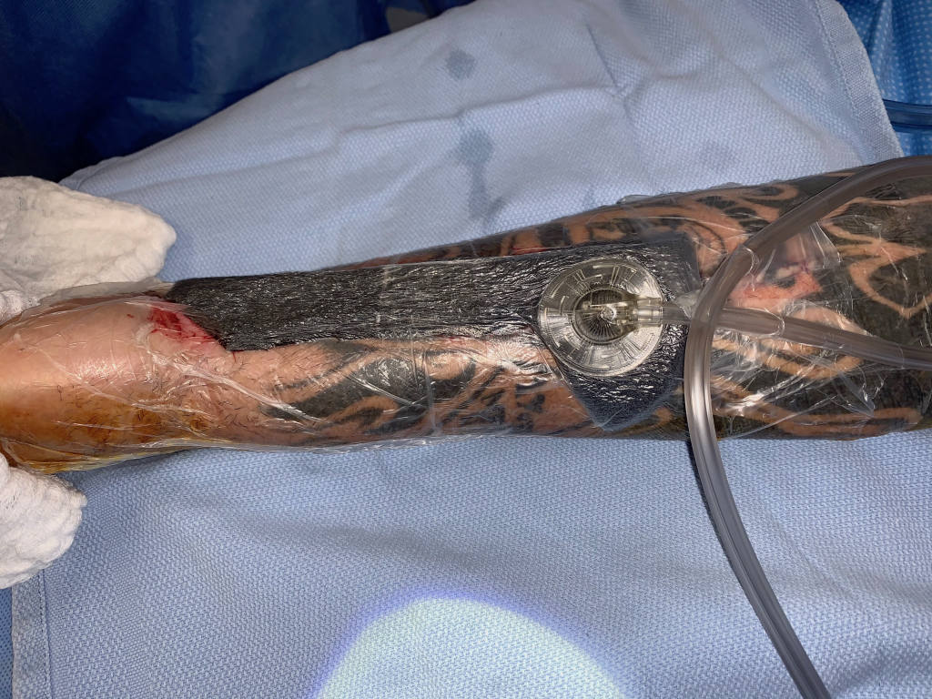 followed by KCI•3M® wound V.A.C.