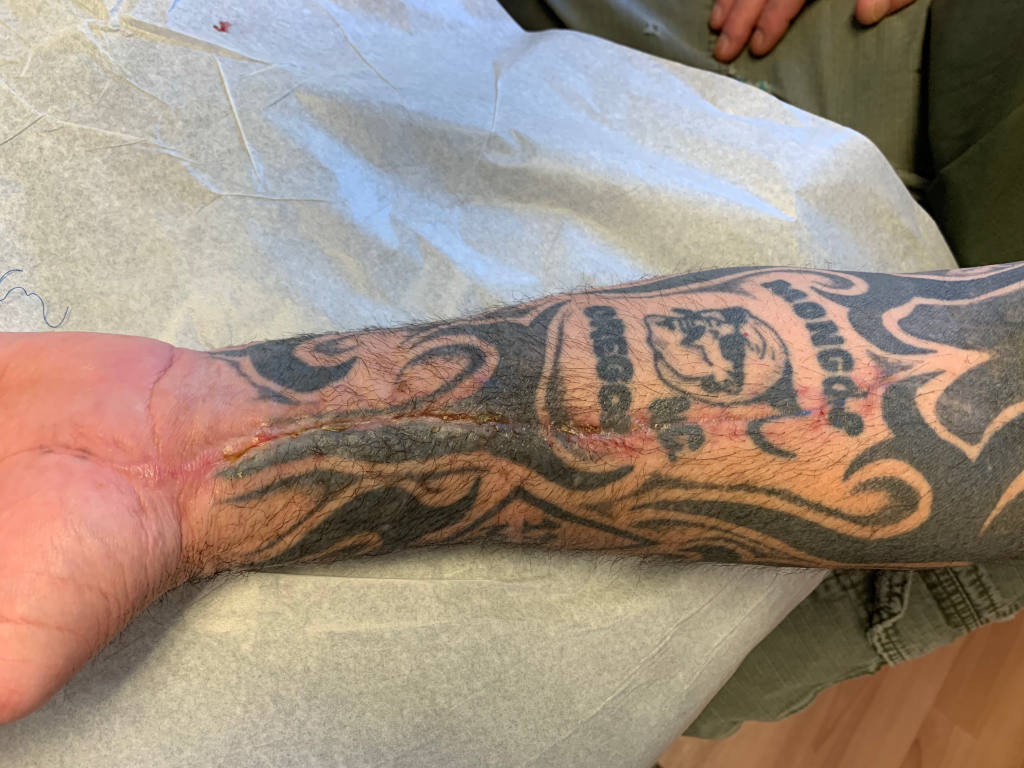 Wound completely healed in 49 days and with normal hand/wrist function.