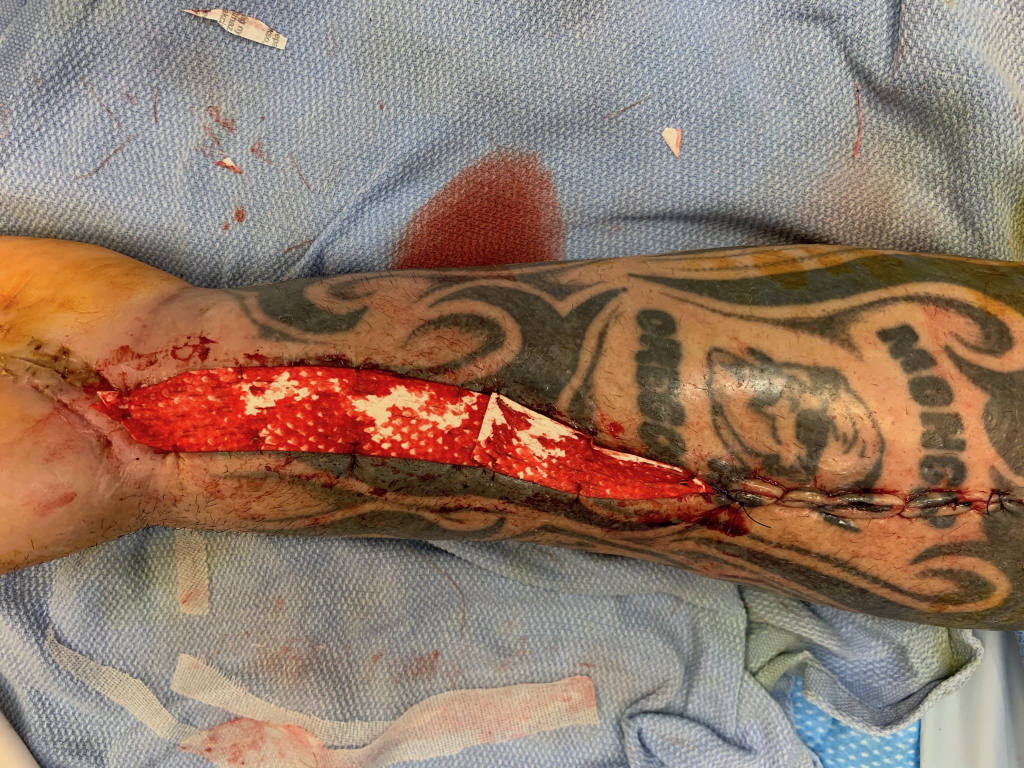 The tendon was covered with Kerecis® fish skin.