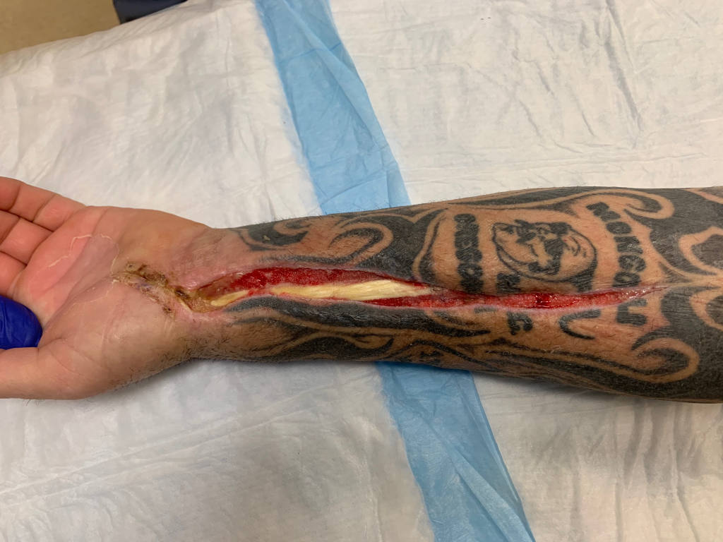 40 year old male who developed necrotizing fasciitis (some call it a "flash-eating bacteria") of the forearm.  The resulting (decompressive fasciotomy) wound could not be suture-closed leaving flexor tendon exposed..