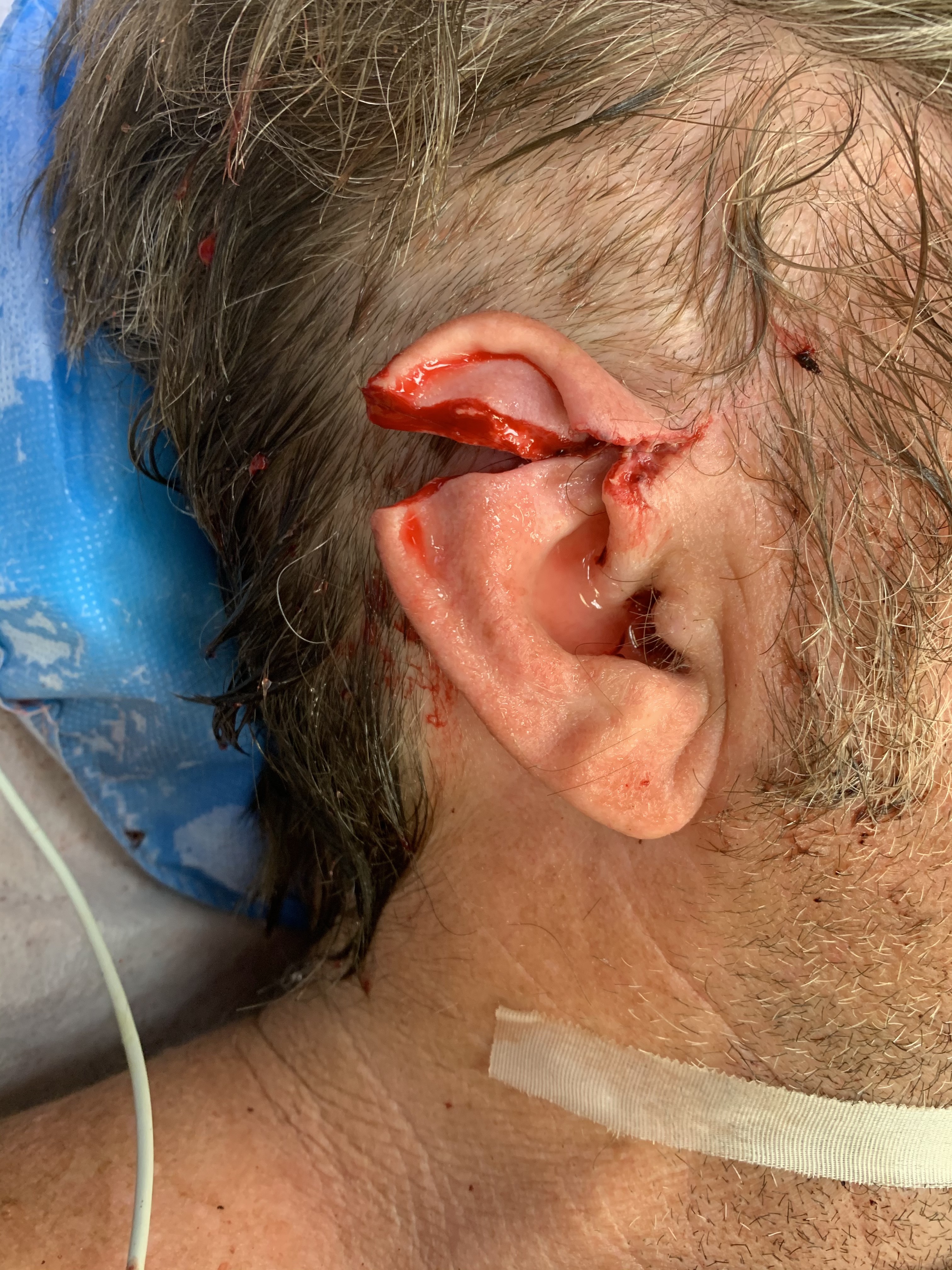 30-something surfer who caught a bad wave with the fin of the surf board nearly amputating his ear.