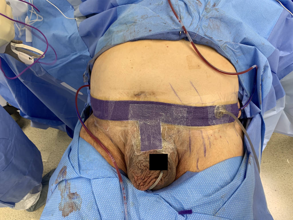 To assist with wound healing, Dr. Baeke applied the KCI•3m Prevena wound V.A.C. (purple foam).