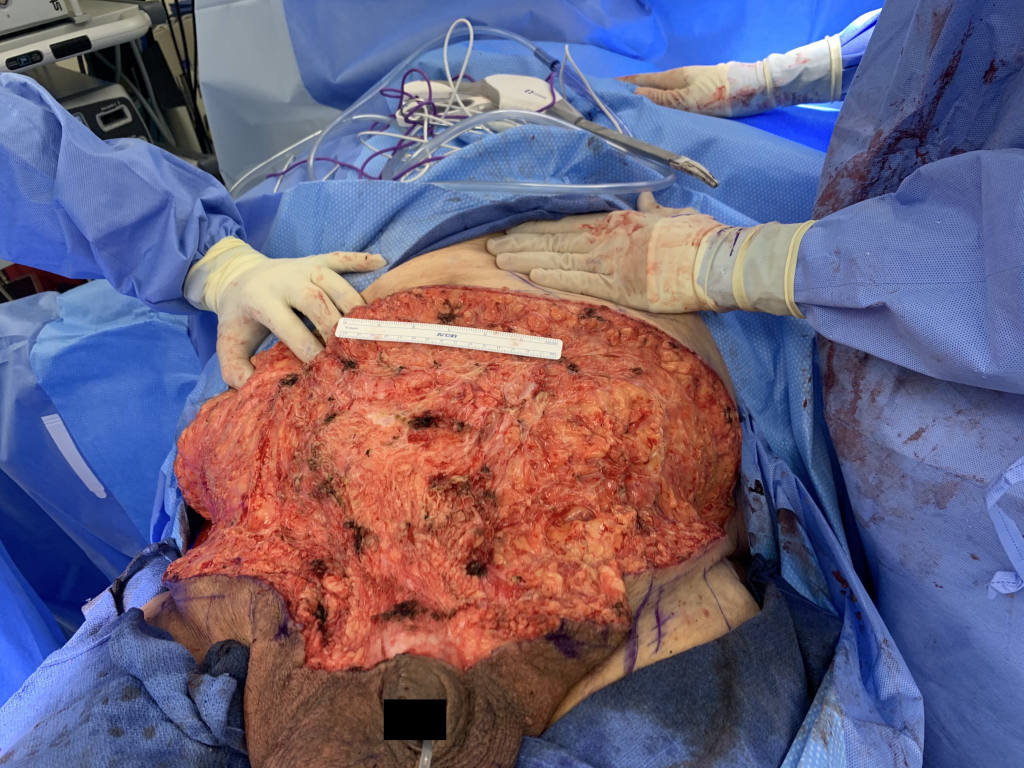 The surgery was complex and resulted in a wound measuring 70cm across.