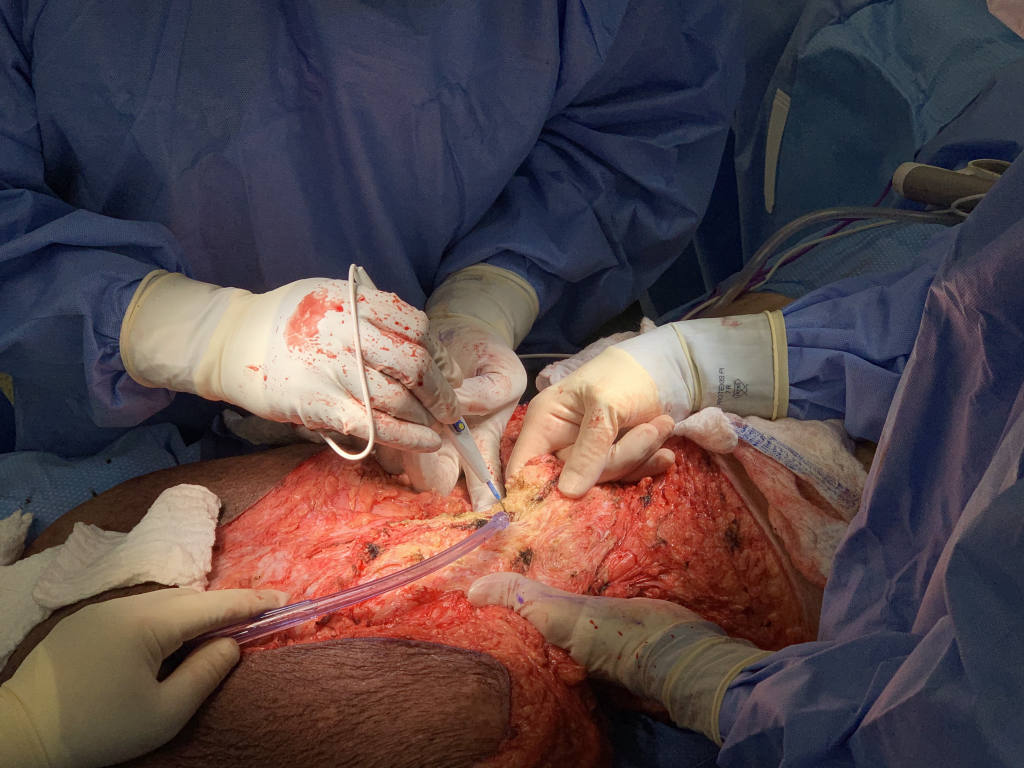 The surgery was complex and resulted in a wound measuring 70cm across.