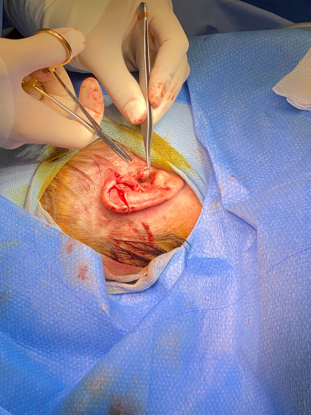 30-something surfer who caught a bad wave with the fin of the surf board nearly amputating his ear.