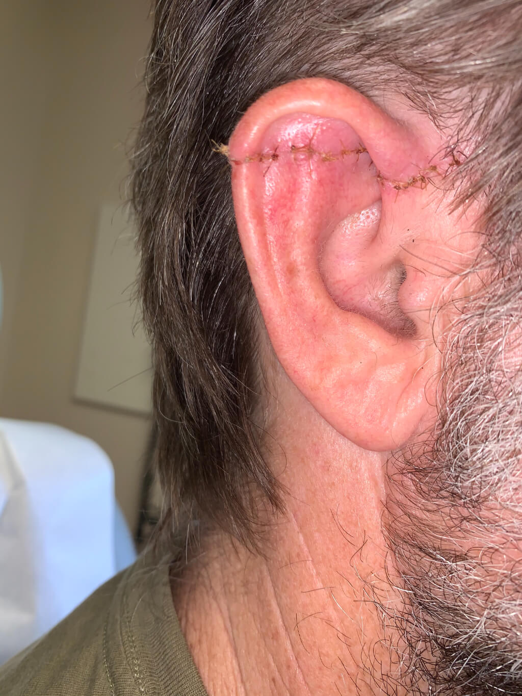 30-something surfer who caught a bad wave with the fin of the surf board nearly amputating his ear.