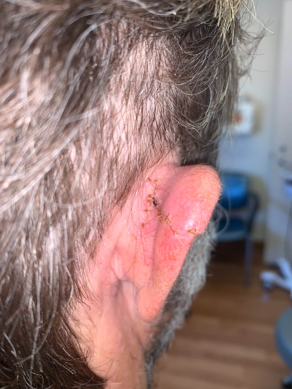 30-something surfer who caught a bad wave with the fin of the surf board nearly amputating his ear.
