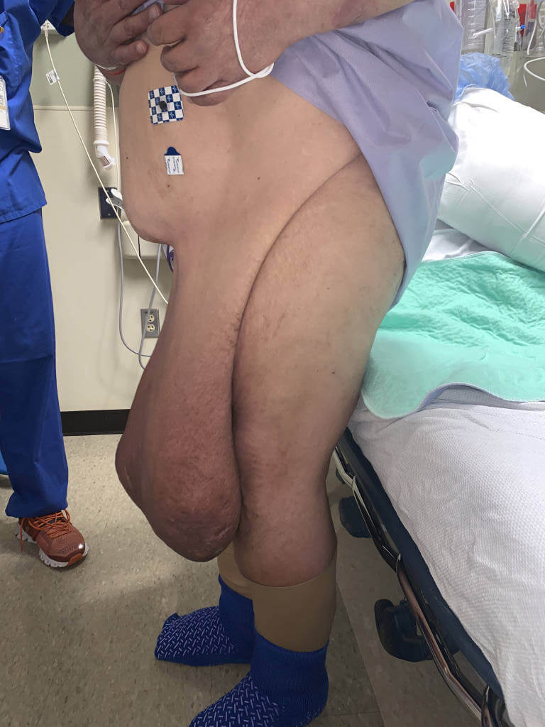 70-something obese male with a 34 year history of a slowly growing tumor (called a lymphocele or massive localized lymphedema) hanging from his abdominal wall and genitalia.