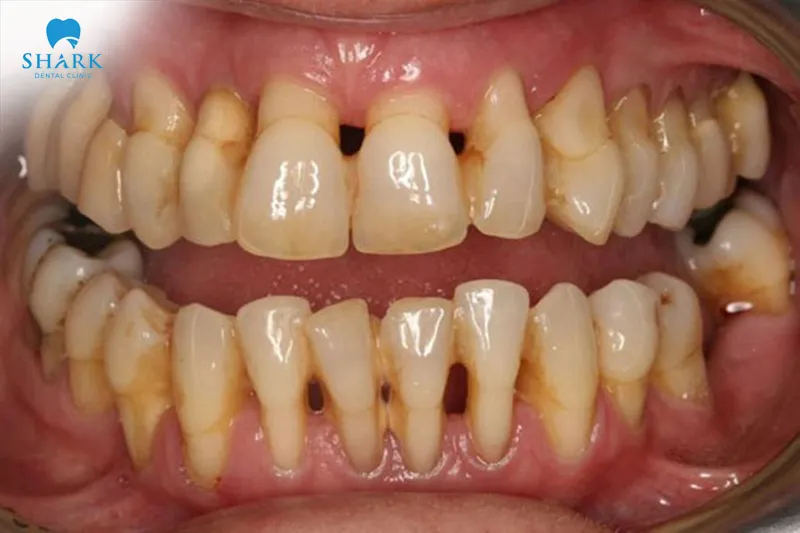 Tác hại dán sứ