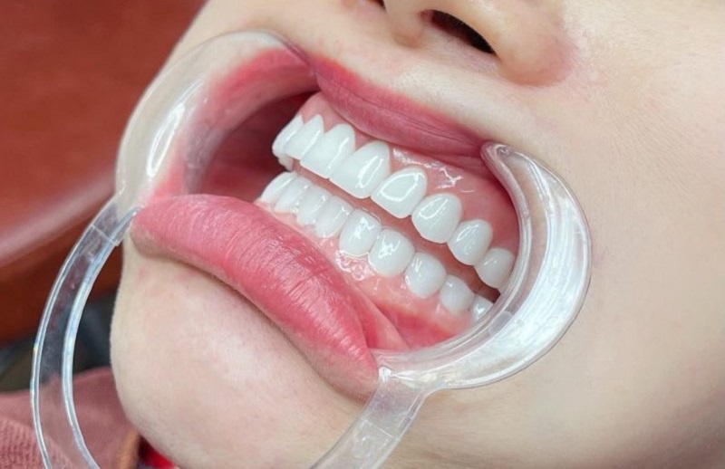Răng sứ Orodent