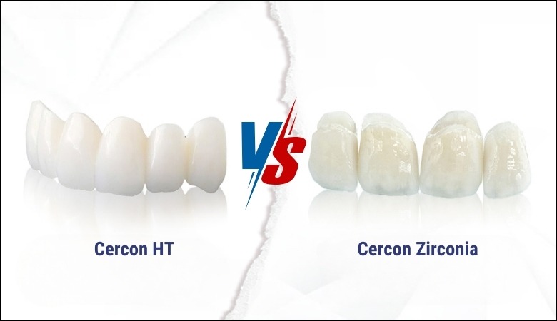 Răng sứ cercon: Giải pháp tối ưu cho nụ cười hoàn hảo