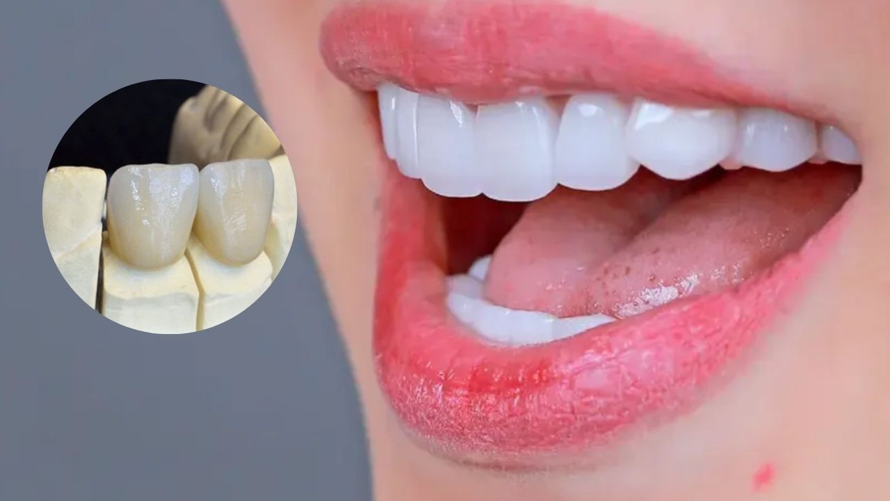 Răng sứ giá 2 triệu có tốt không? phù hợp với ai