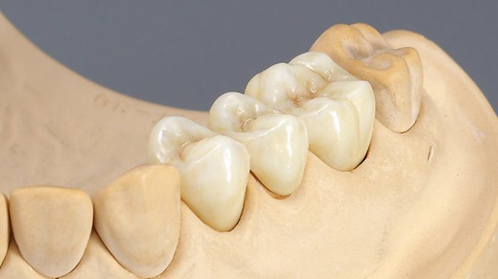 Bọc răng sứ cho răng bị mẻ bằng loại nào tốt nhất?