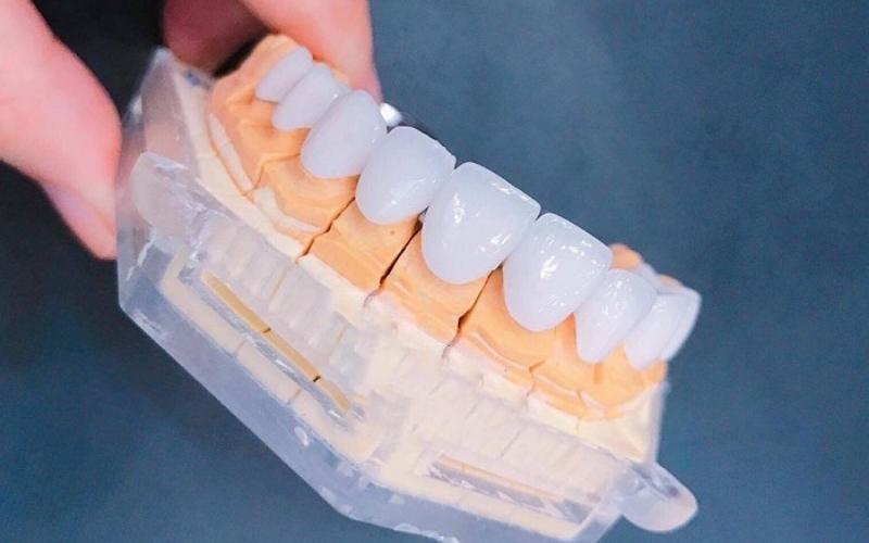 Răng sứ Orodent - Nha Khoa Lavener