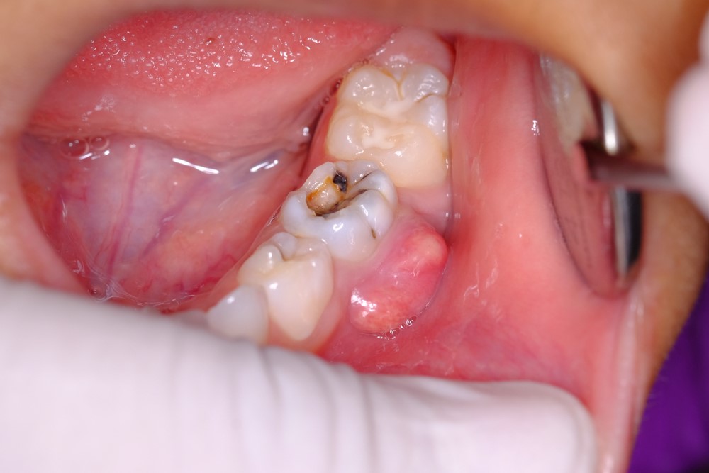 Viêm Tủy Răng Có Mủ: Nguyên Nhân Và Cách Điều Trị