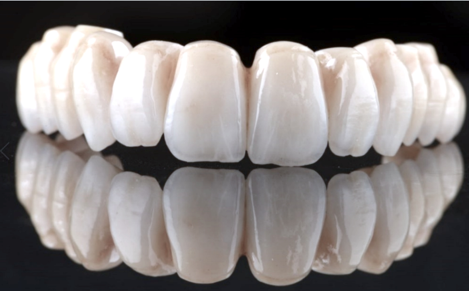 Dán sứ veneer Emax thẩm mỹ - Nha khoa Parkway - Người bạn trọn đời