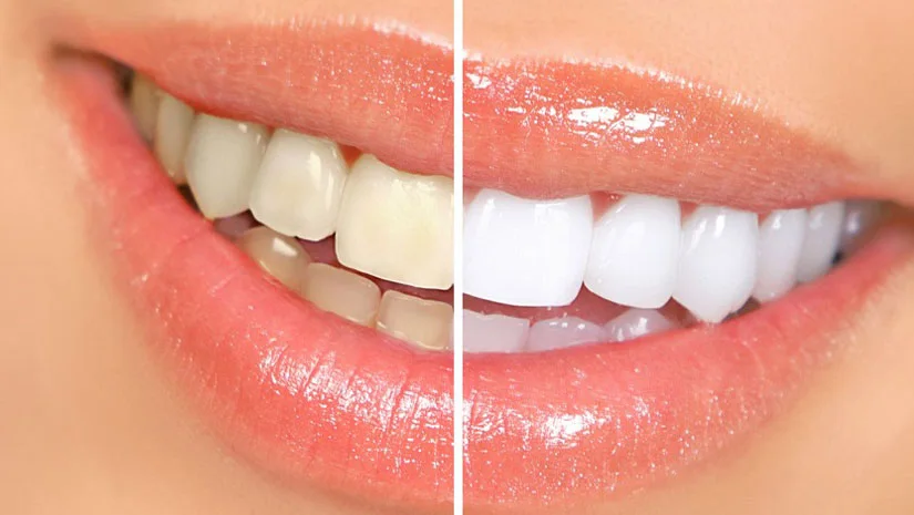 Chi phí tẩy trắng răng giá bao nhiêu tiền? Bảng giá