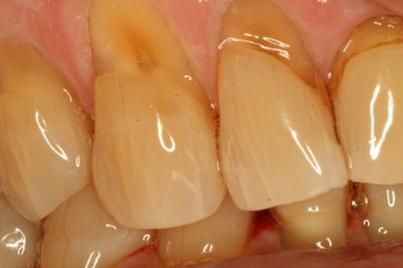 Mòn cổ chân răng có ảnh hưởng đến sức khỏe không?