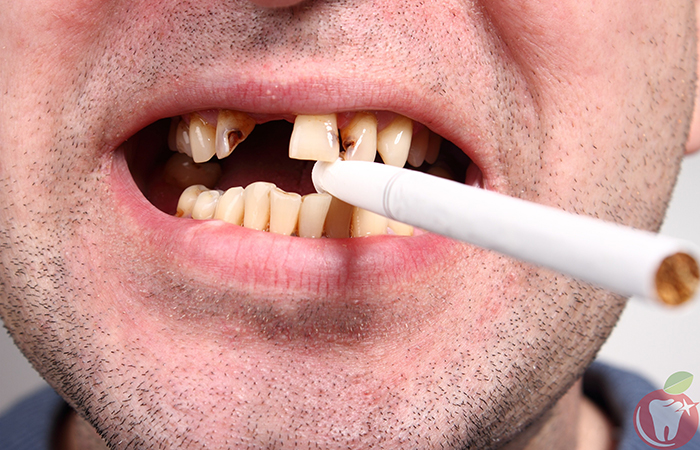 Tác hại của việc hút thuốc lá lên sức khoẻ răng miệng