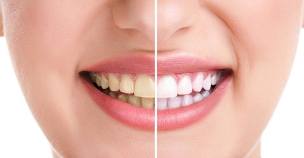 Bị vàng răng? Nguyên nhân và cách điều trị răng bị ố vàng