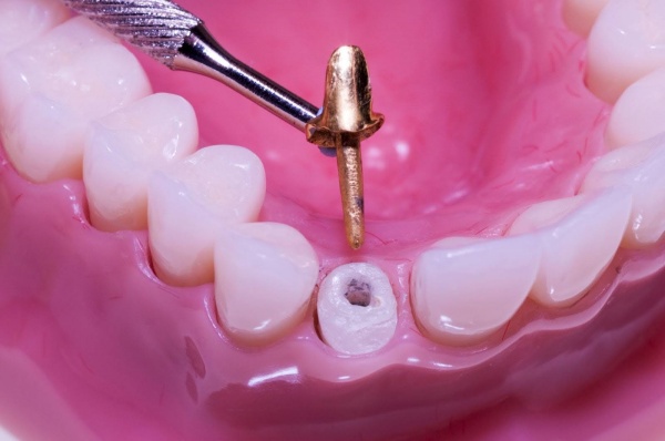 Làm cùi giả là gì? Có mấy loại, trường hợp nào cần gắn cùi giả?