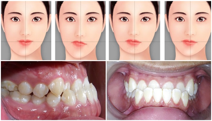 Khớp cắn chuẩn là như thế nào? Các dạng sai khớp cắn thường gặp -  nhakhoathuyanh