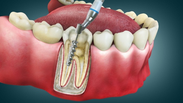 Răng bọc sứ bị viêm tủy có nguy hiểm không, chữa thế nào?