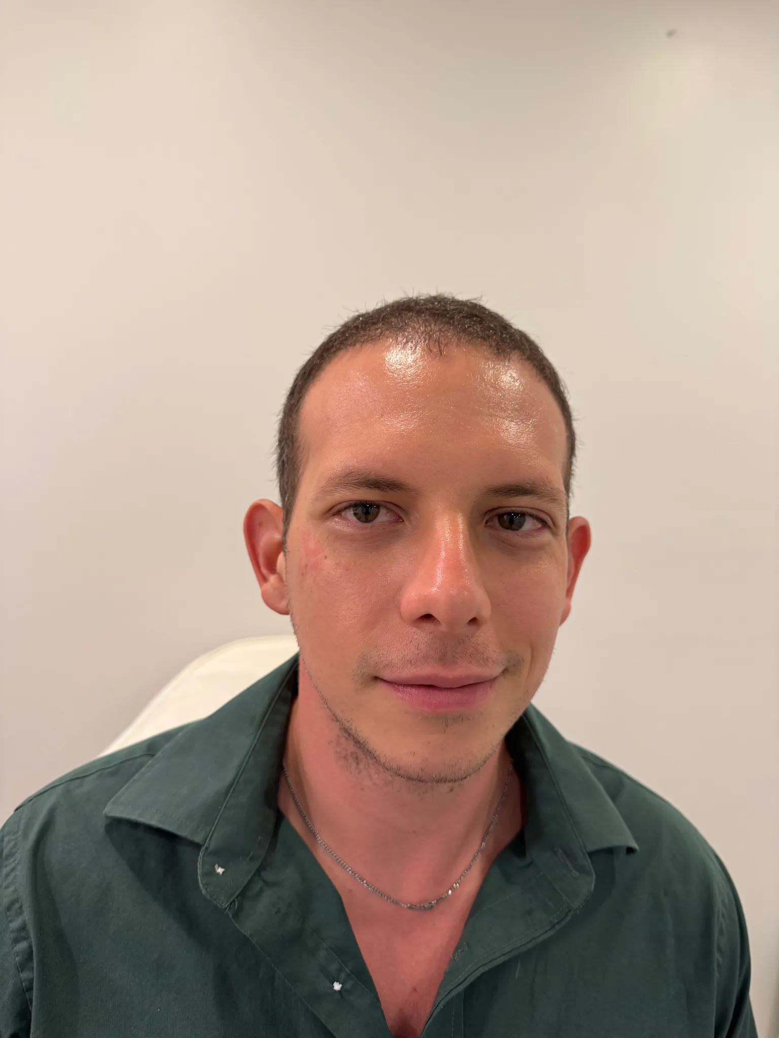 Glass lift skin rejuvenation after results