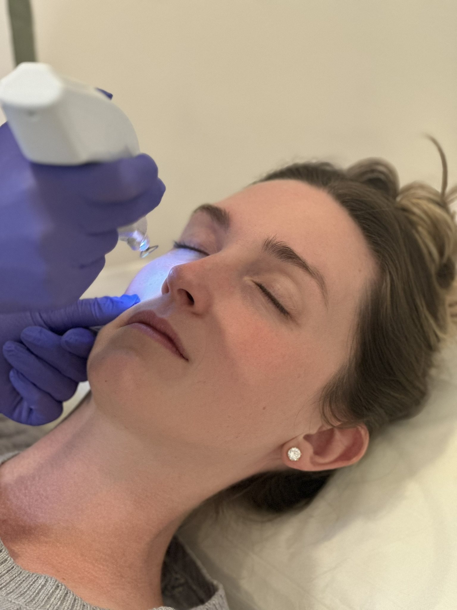 Plasma (Plexr) soft-surgery treatment at Arbour Longevity
