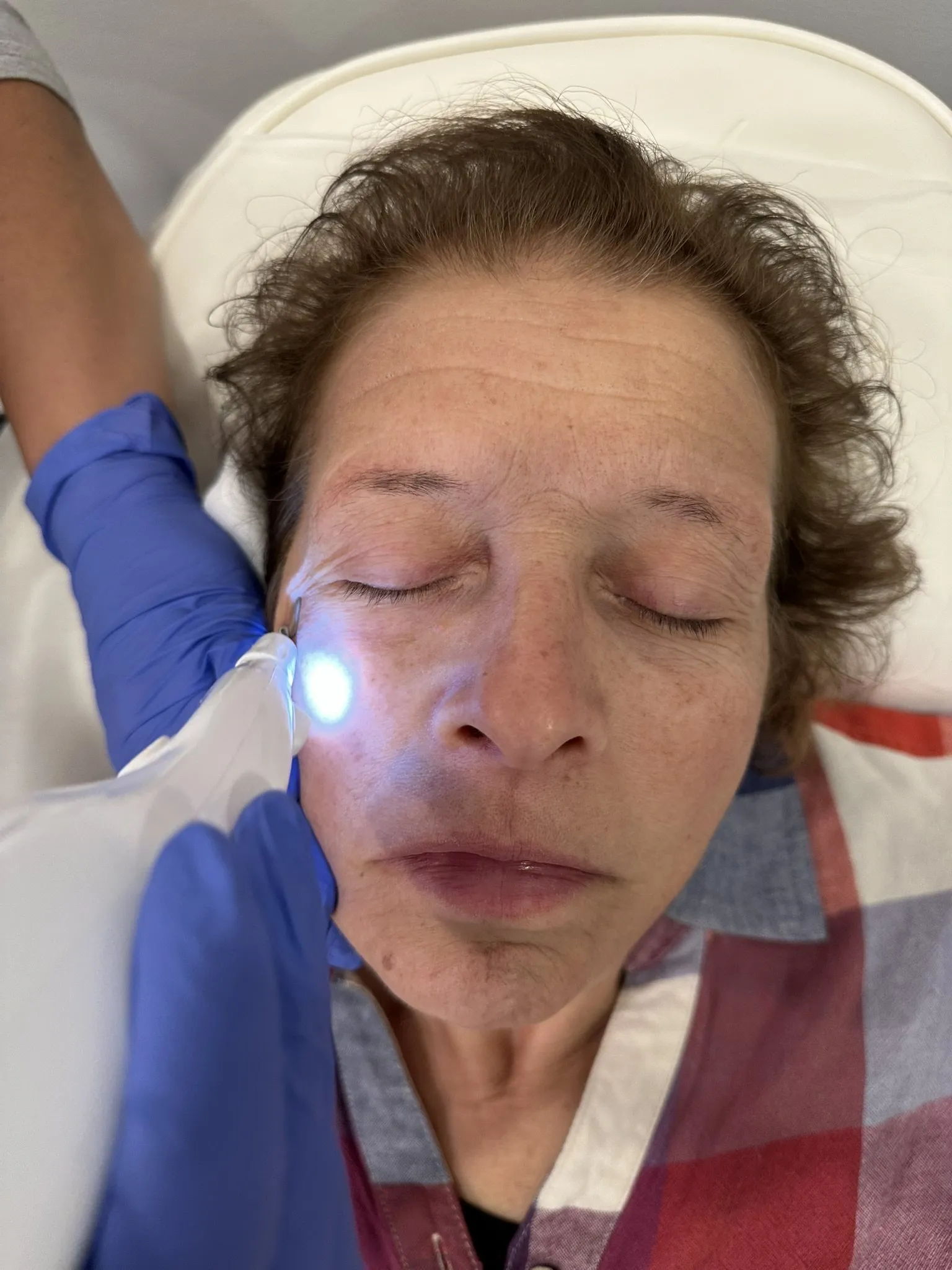 Precision plasma resurfacing soft surgery treatment