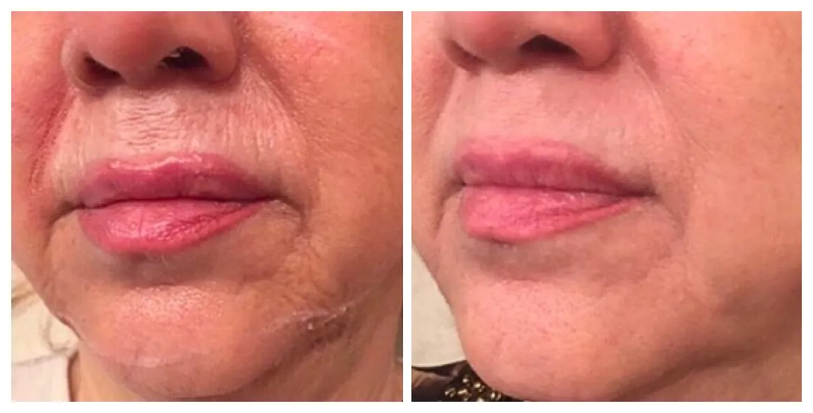 Eyelid rejuvenation results after plasma soft surgery